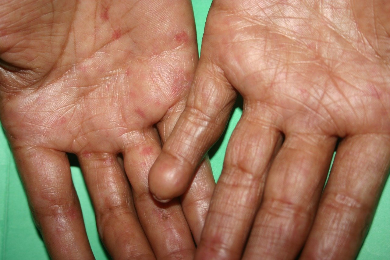 Instituto Dermatológico sostiene que en caso de confirmarse enfermedad de escabiasis en Haití el país cuenta con tratamientos para su cura
